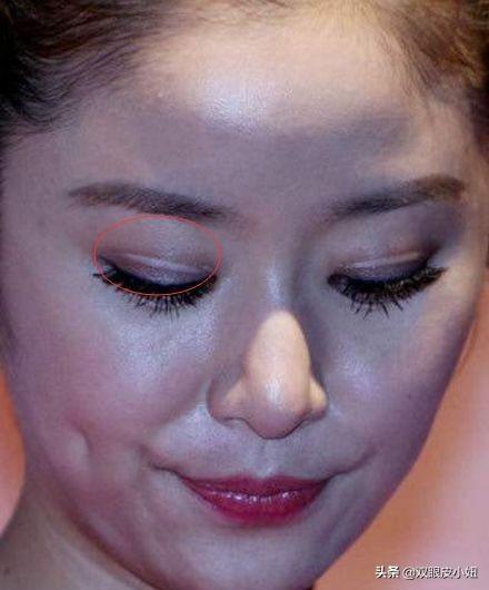 明星网红贴双眼皮,明星同款眼眸养成记